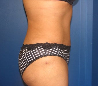 Tummy Tuck