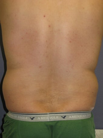 Liposuction Male