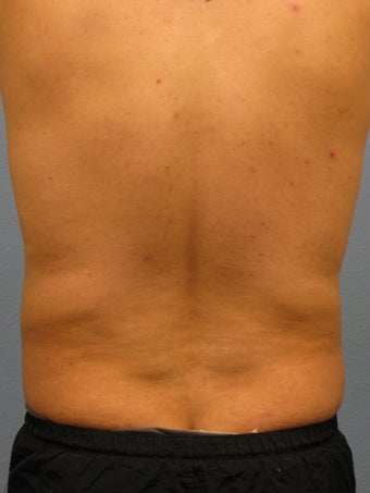 Liposuction Male