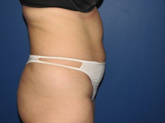 Liposuction