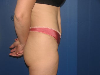 Liposuction