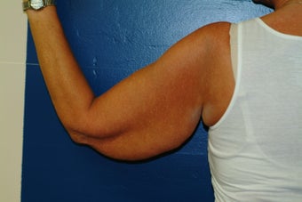 Brachioplasty
