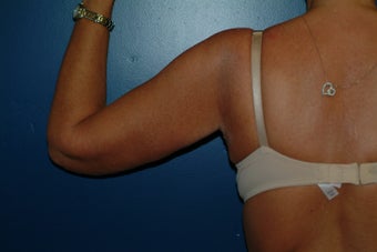 Brachioplasty