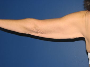 Brachioplasty