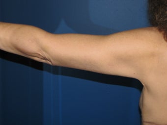 Brachioplasty