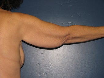 Brachioplasty