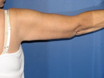 Brachioplasty
