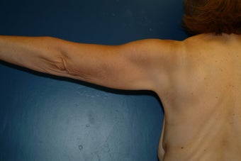 Brachioplasty