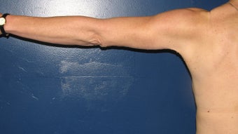 Brachioplasty