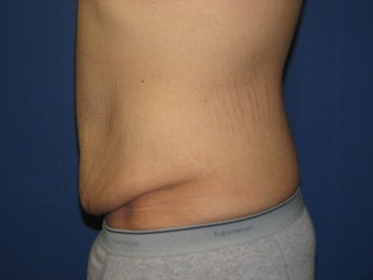 Male Tummy Tuck