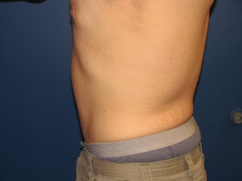 Male Tummy Tuck