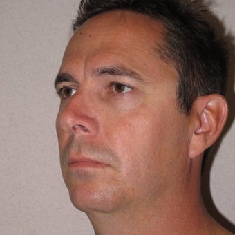 Chin Implant and Neck Liposuction