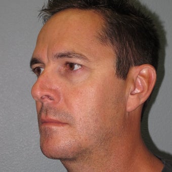 Chin Implant and Neck Liposuction