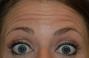 Botox injected in between the eyebrows and into the forehead