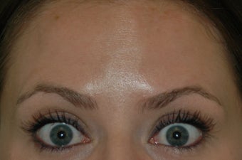 Botox injected in between the eyebrows and into the forehead