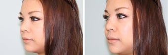Nasal filler