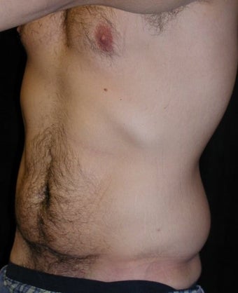 Male tummy Tuck, Flank Liposuction, Male Breast Reduction
