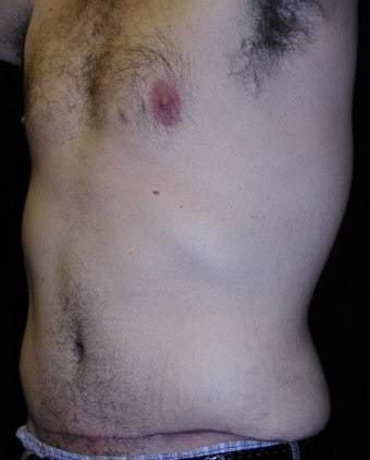 Male tummy Tuck, Flank Liposuction, Male Breast Reduction