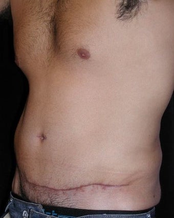 Male tummy Tuck, Flank Liposuction