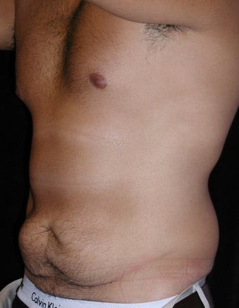 Male tummy Tuck, Flank Liposuction