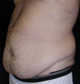Male tummy Tuck