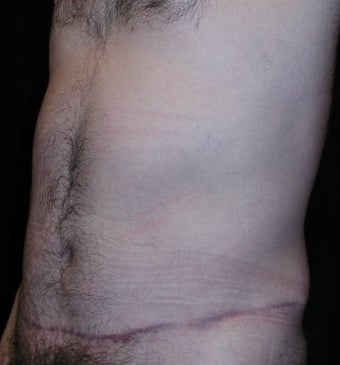 Male tummy Tuck