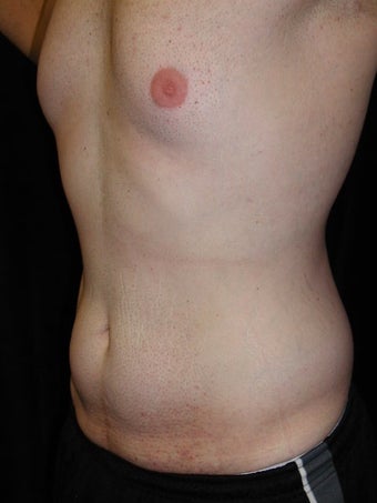 Male Tummy Tuck, Flank Liposuction, Male Breast Reduction