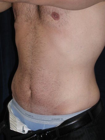 Male Tummy Tuck, Flank Liposuction, Male Breast Reduction