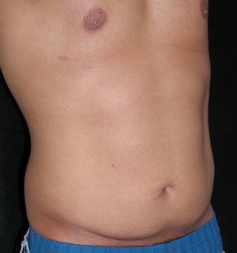 Male tummy Tuck, Flank Liposuction