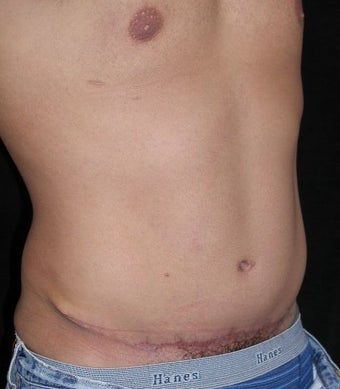 Male tummy Tuck, Flank Liposuction