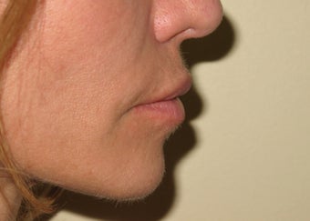lip lift