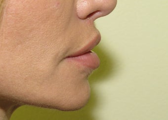 lip lift
