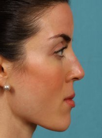 Revision Rhinoplasty
