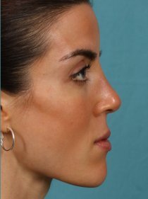 Revision Rhinoplasty