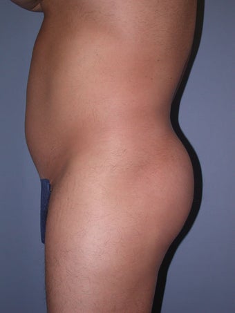 Liposuction