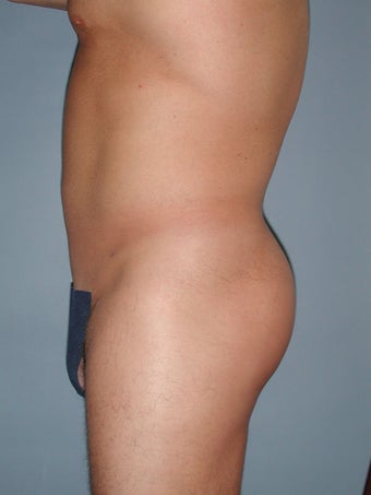 Liposuction