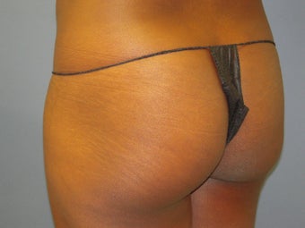 Fat Transfer