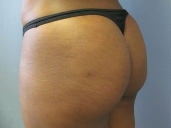 Fat Transfer
