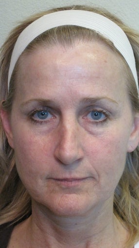 Sculptra and juvederm