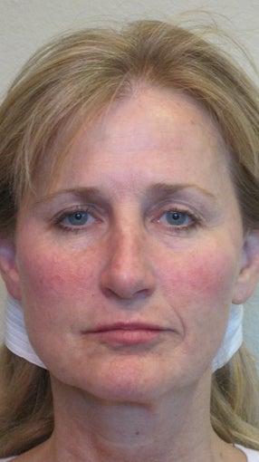 Sculptra and juvederm