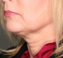 Ultherapy
