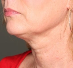 Ultherapy