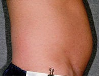 Liposonix