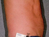 Liposonix