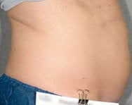 Liposonix