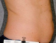 Liposonix