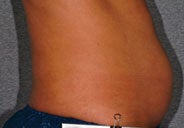 Liposonix