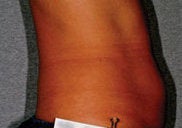 Liposonix