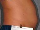 Liposonix