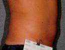 Liposonix
